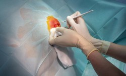 Breast Cysts