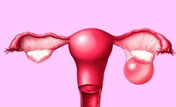 Endometriotic Cyst